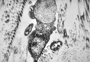 M, 10y. | Coffin-Lowry syndrome - skin M, 10y. | Coffin-Lowry syndrome - skin